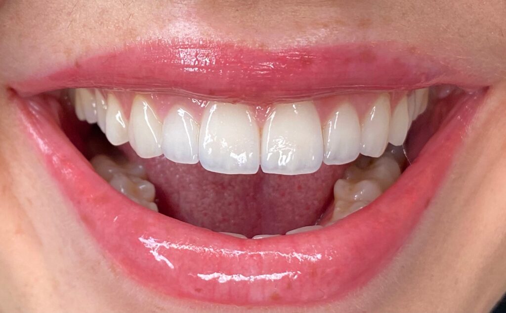 Doğal gülüş tasarımı hollywood smile
