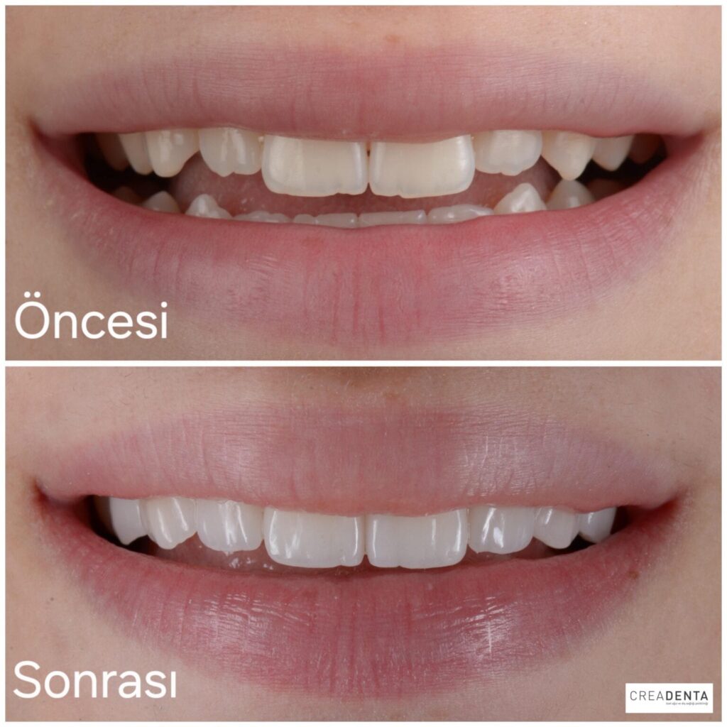 hollywood smile doğal gülüş tasarımı