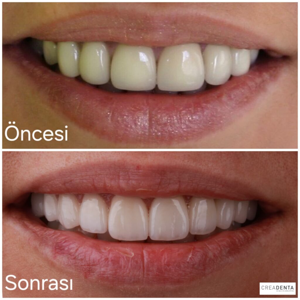 porselen kuronlar