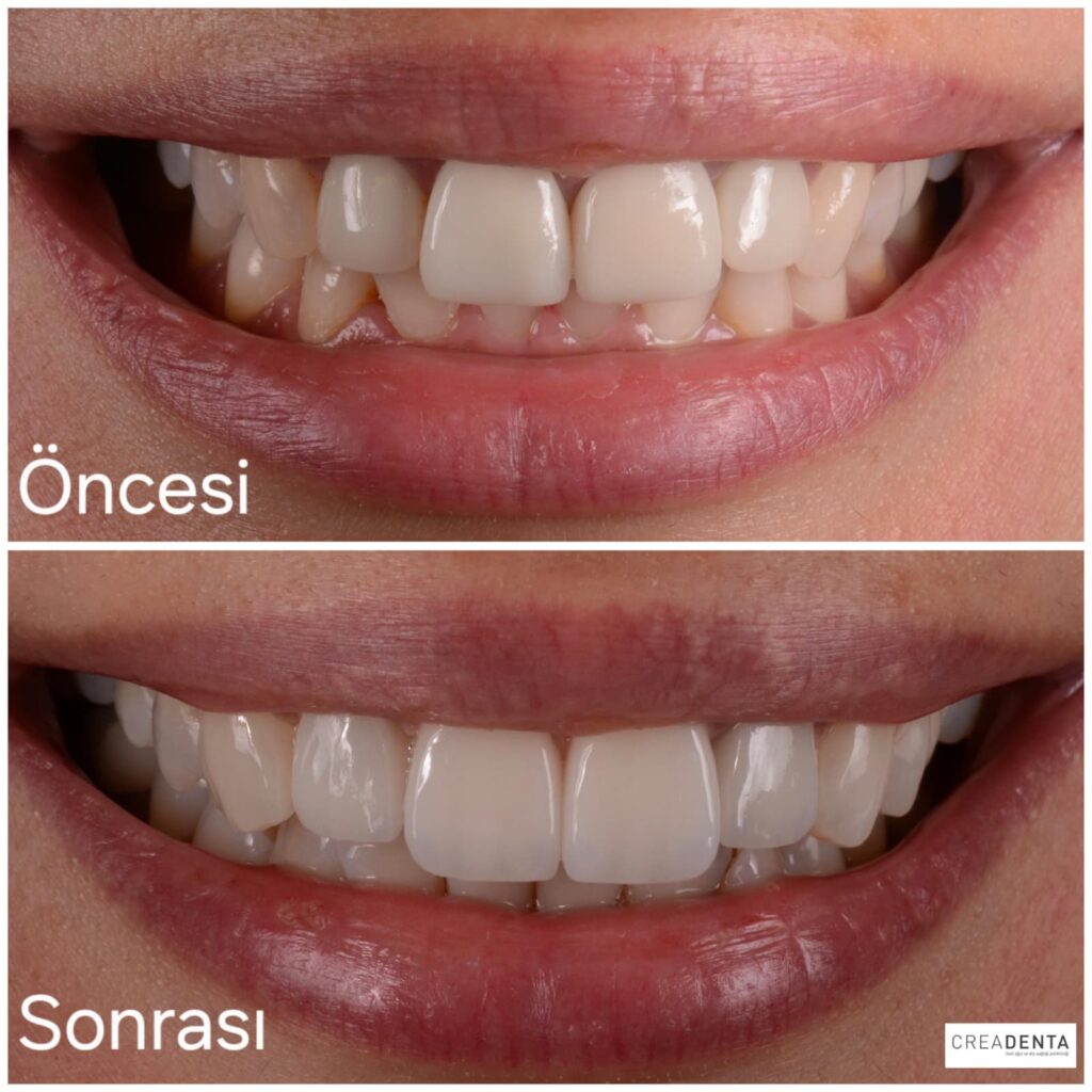 porselen kuronlar e-max kuronlar