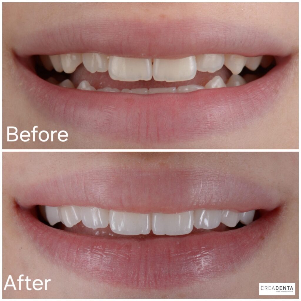 before-after-hollywood-smile