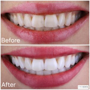 before-after-teeth-whitening