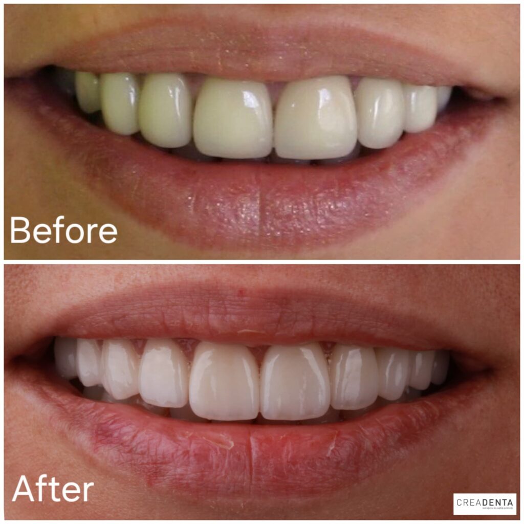 before-after-porcelain-crowns