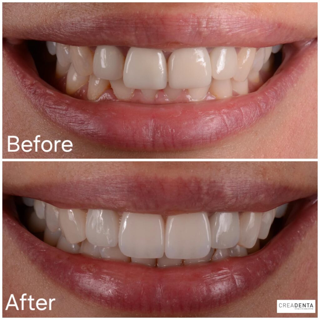 before-after-porcelain-crowns-2