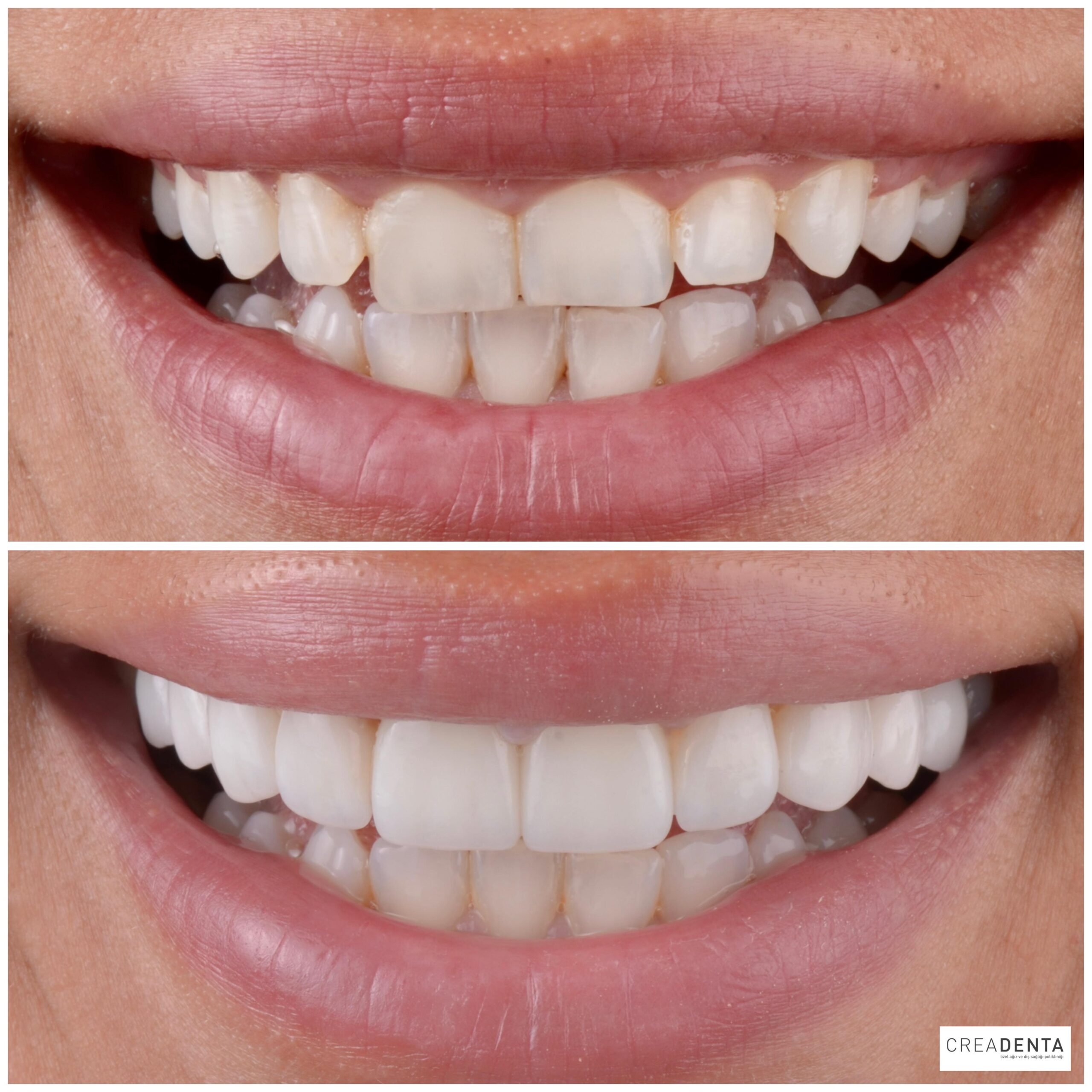 Before Porcelain Veneers