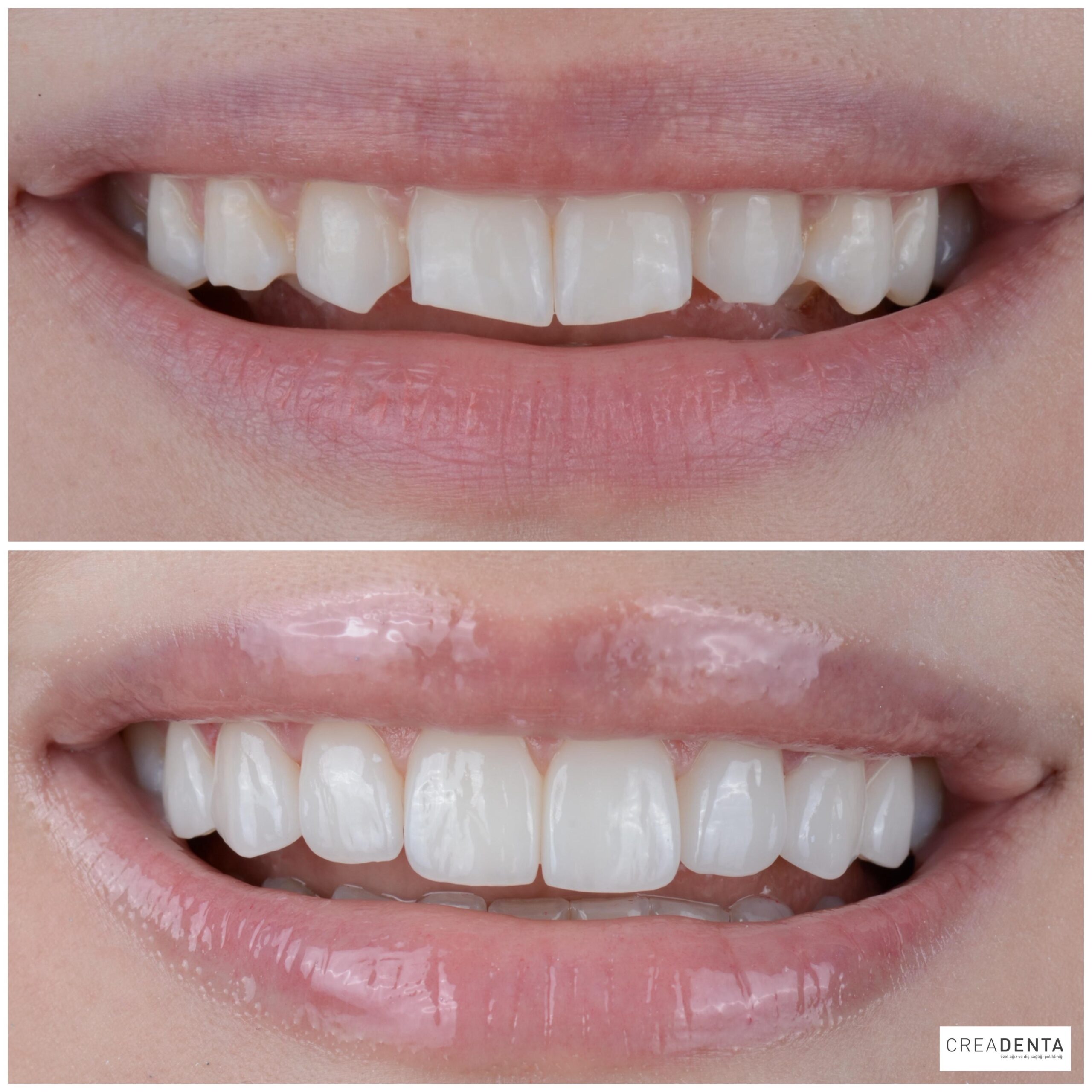 Before Porcelain Veneers