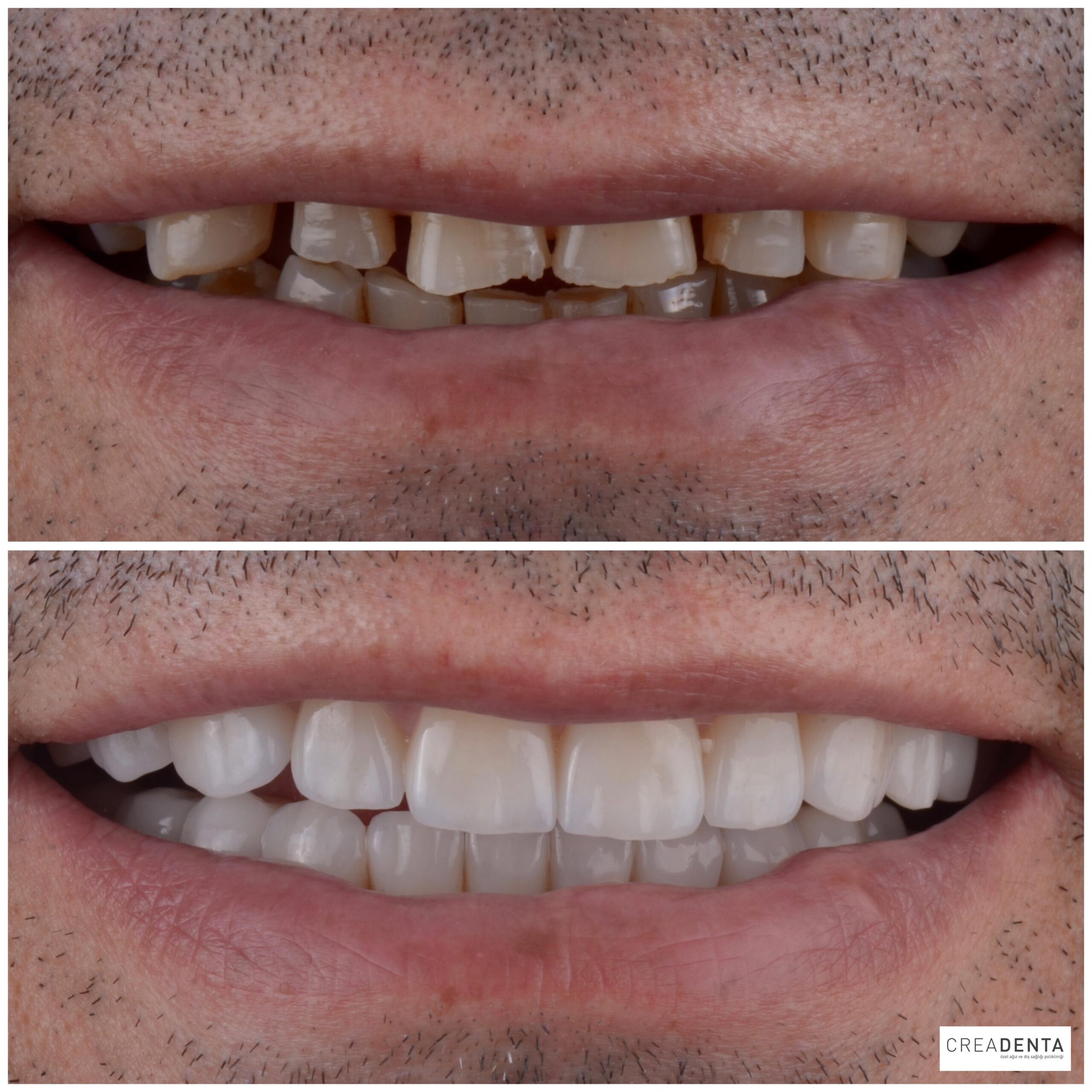 Before Porcelain Veneers