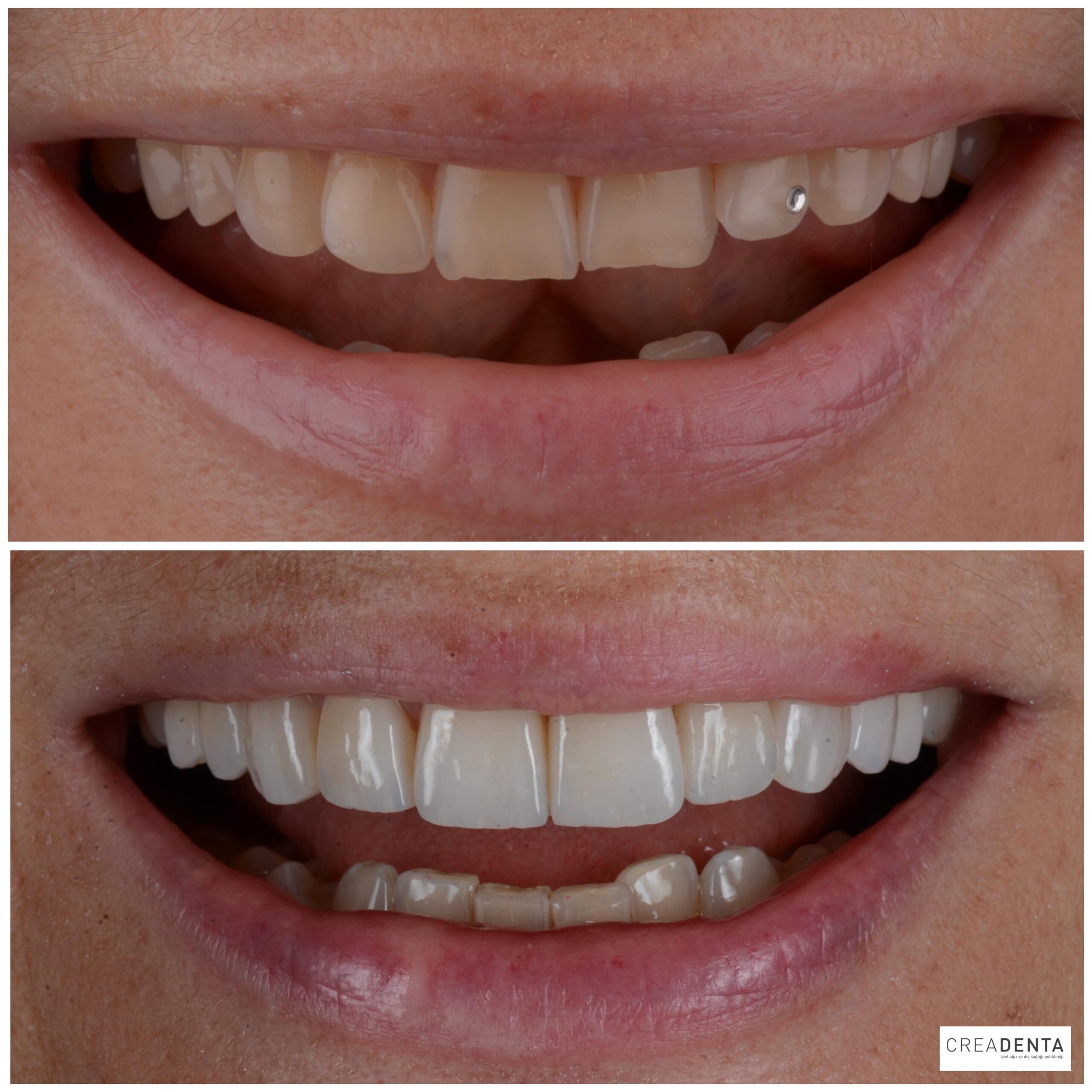 Before Porcelain Veneers