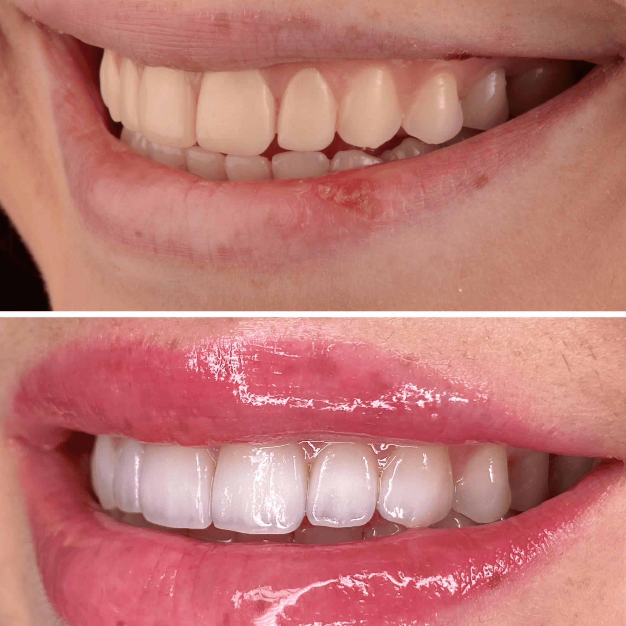 Before Porcelain Veneers