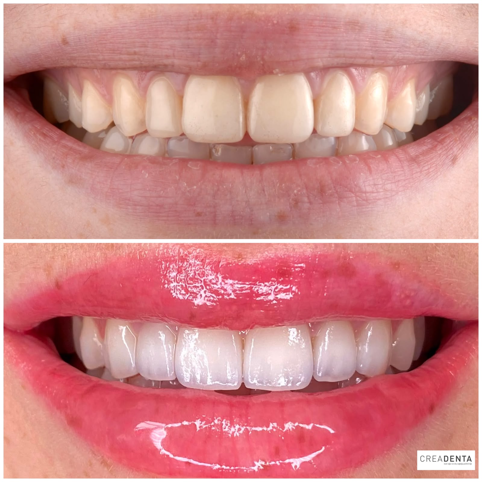 Before Porcelain Veneers