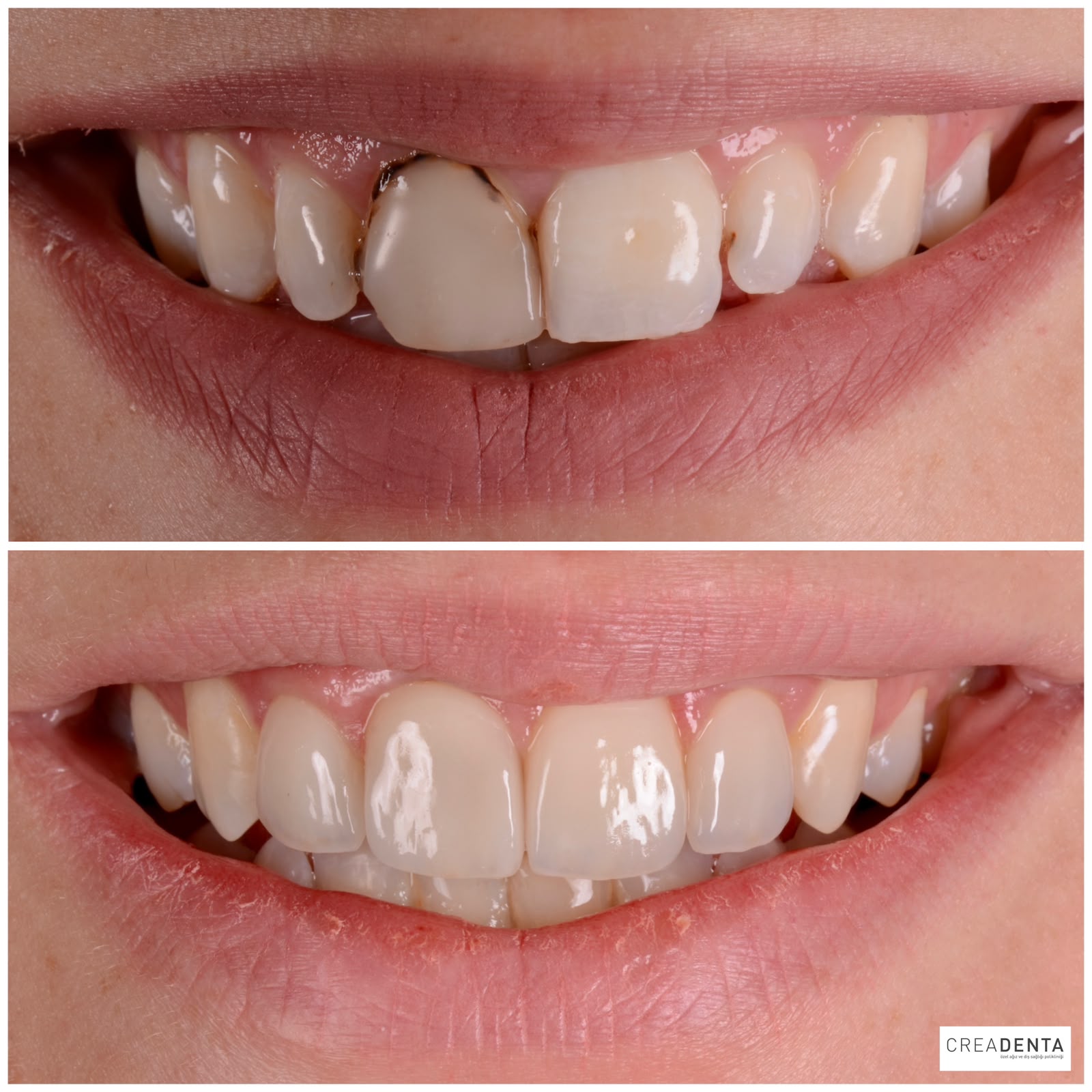Before Porcelain Veneers