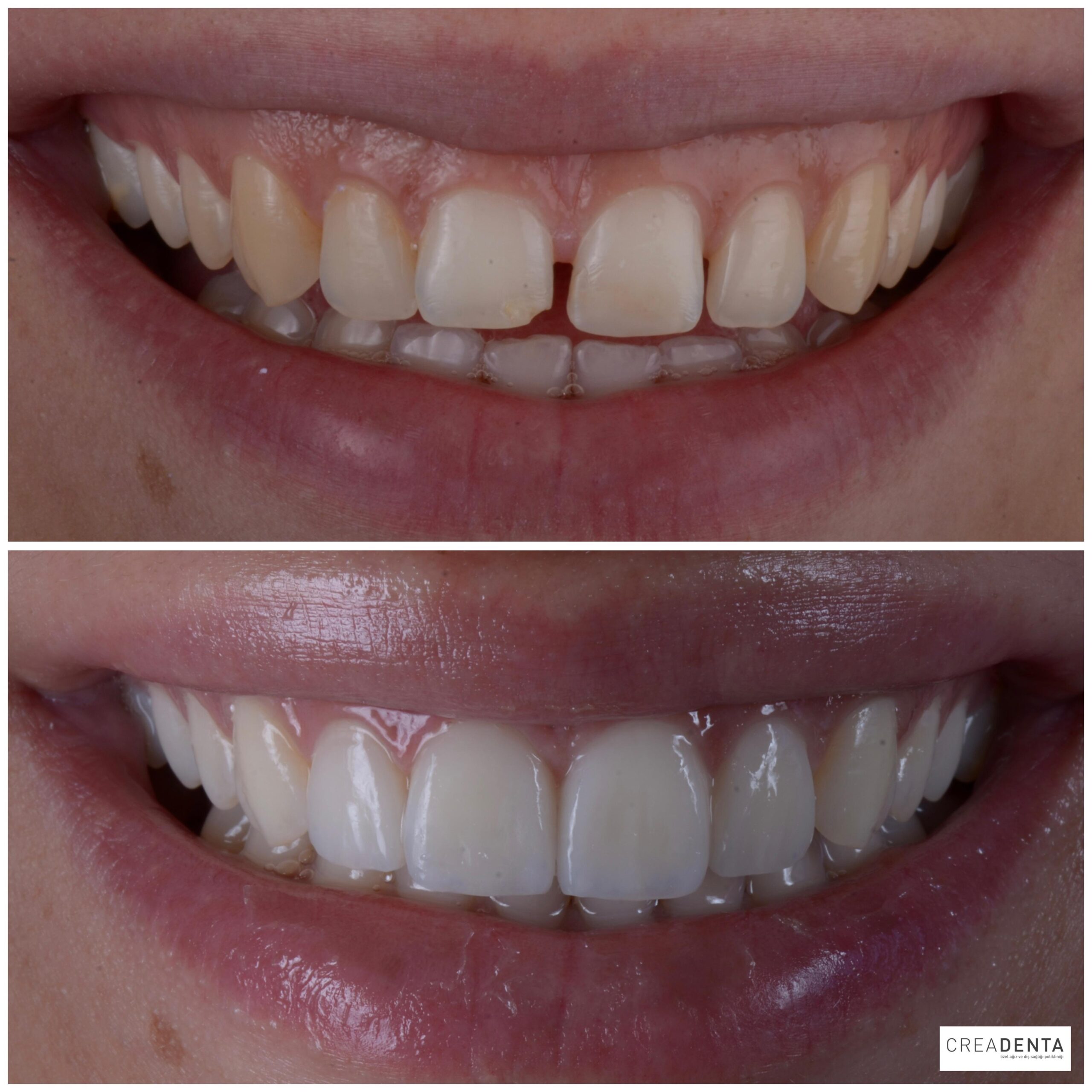 Before Porcelain Veneers