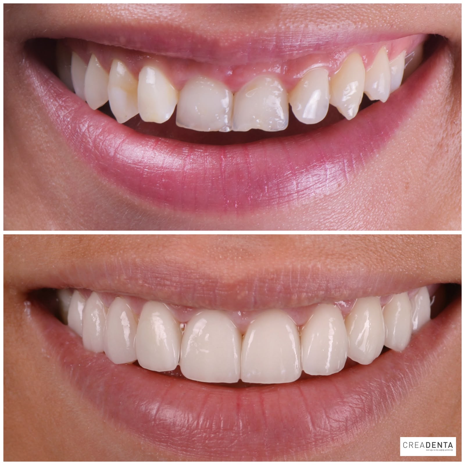 Before Porcelain Veneers