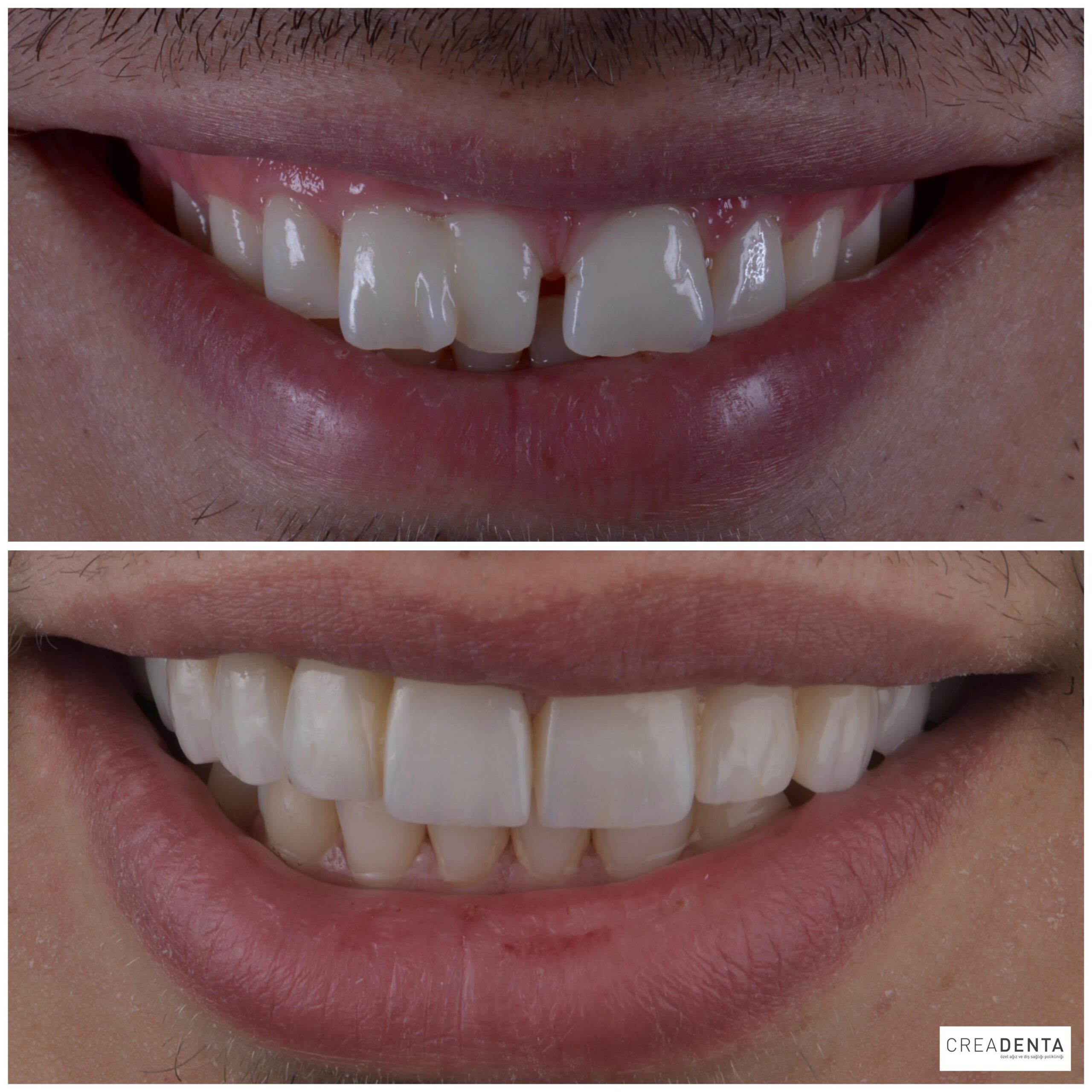 Before Porcelain Veneers