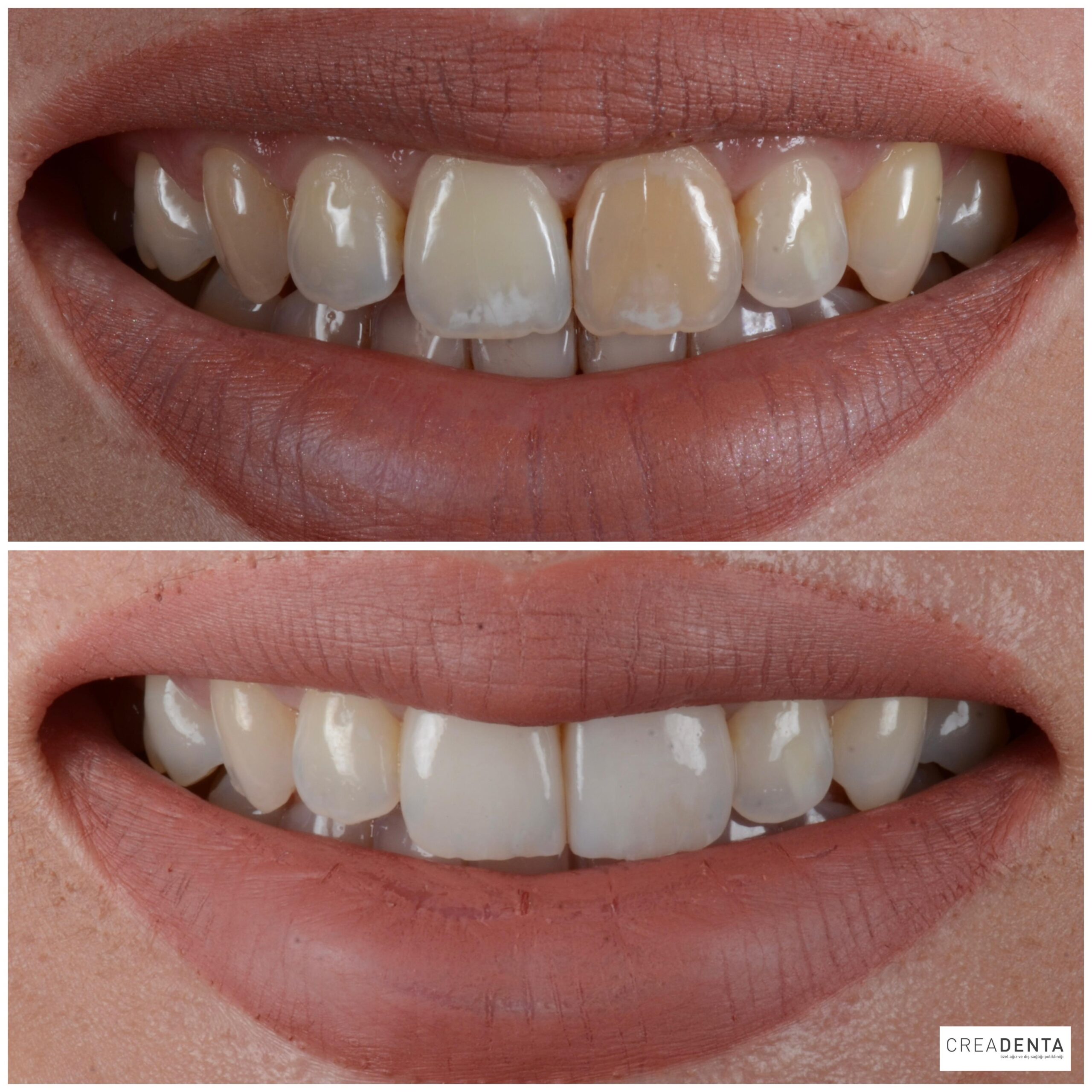 Before Porcelain Veneers