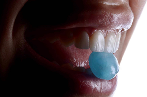 Blue Light After Porcelain Veneers